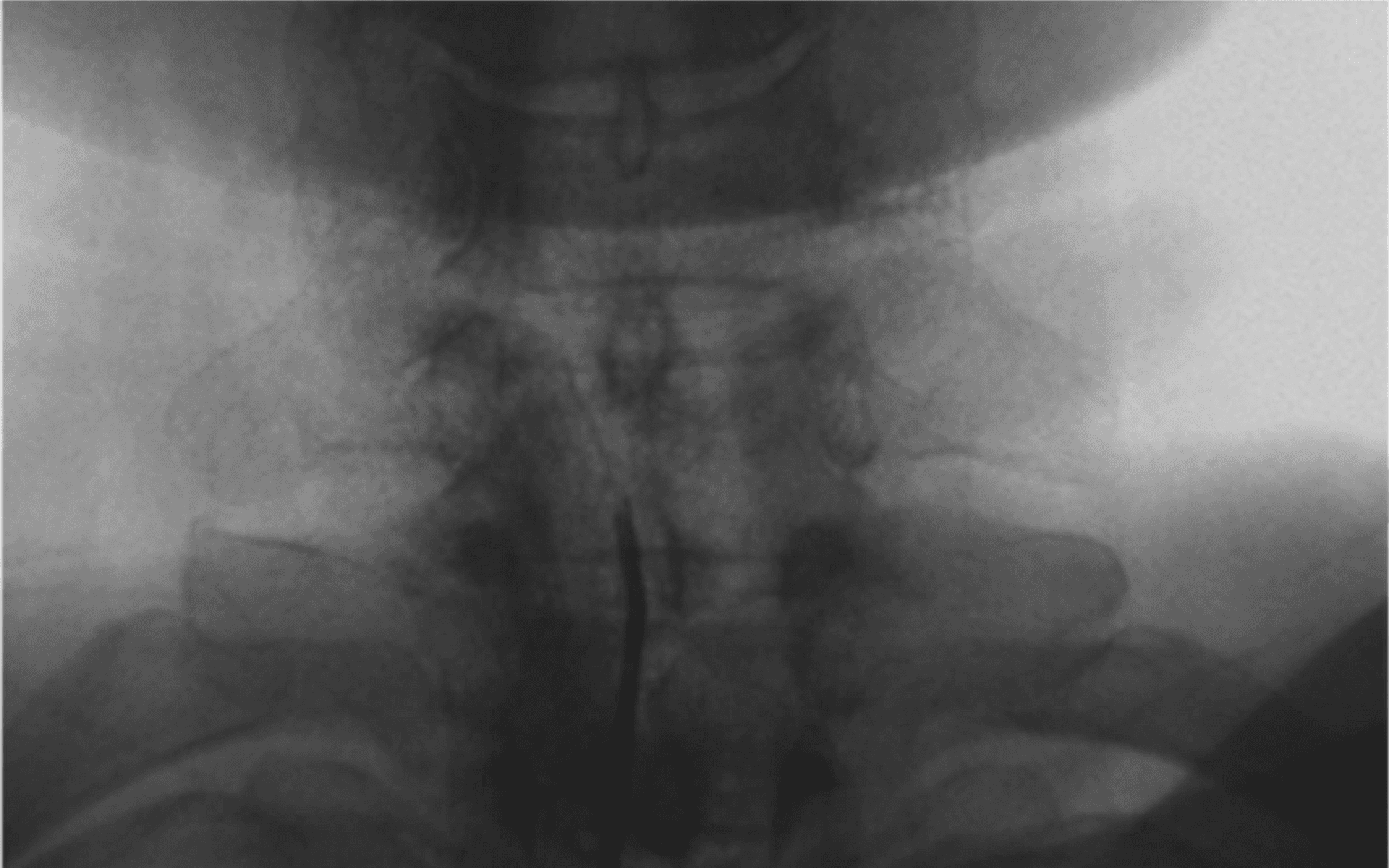 경추 신경성형술 카테터 접근을 확인하는 X-ray 영상