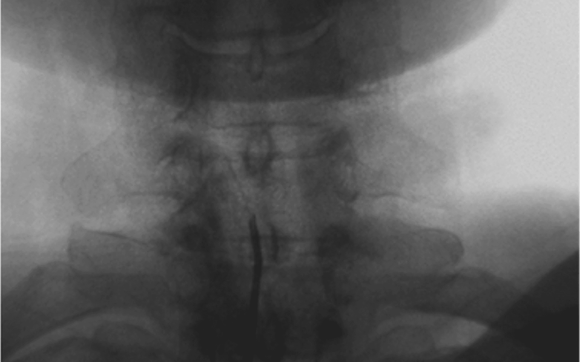 경추 신경성형술 치료 위치를 확인하는 X-ray 영상