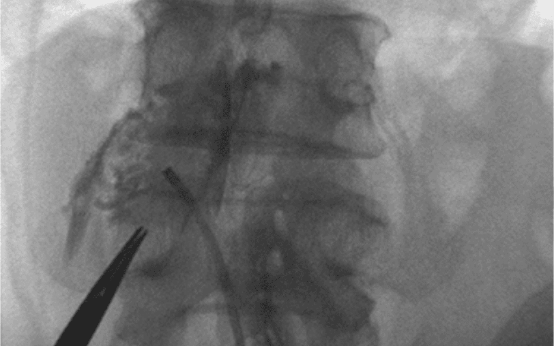 요추 신경성형술 병변 위치를 확인하는 X-ray 영상