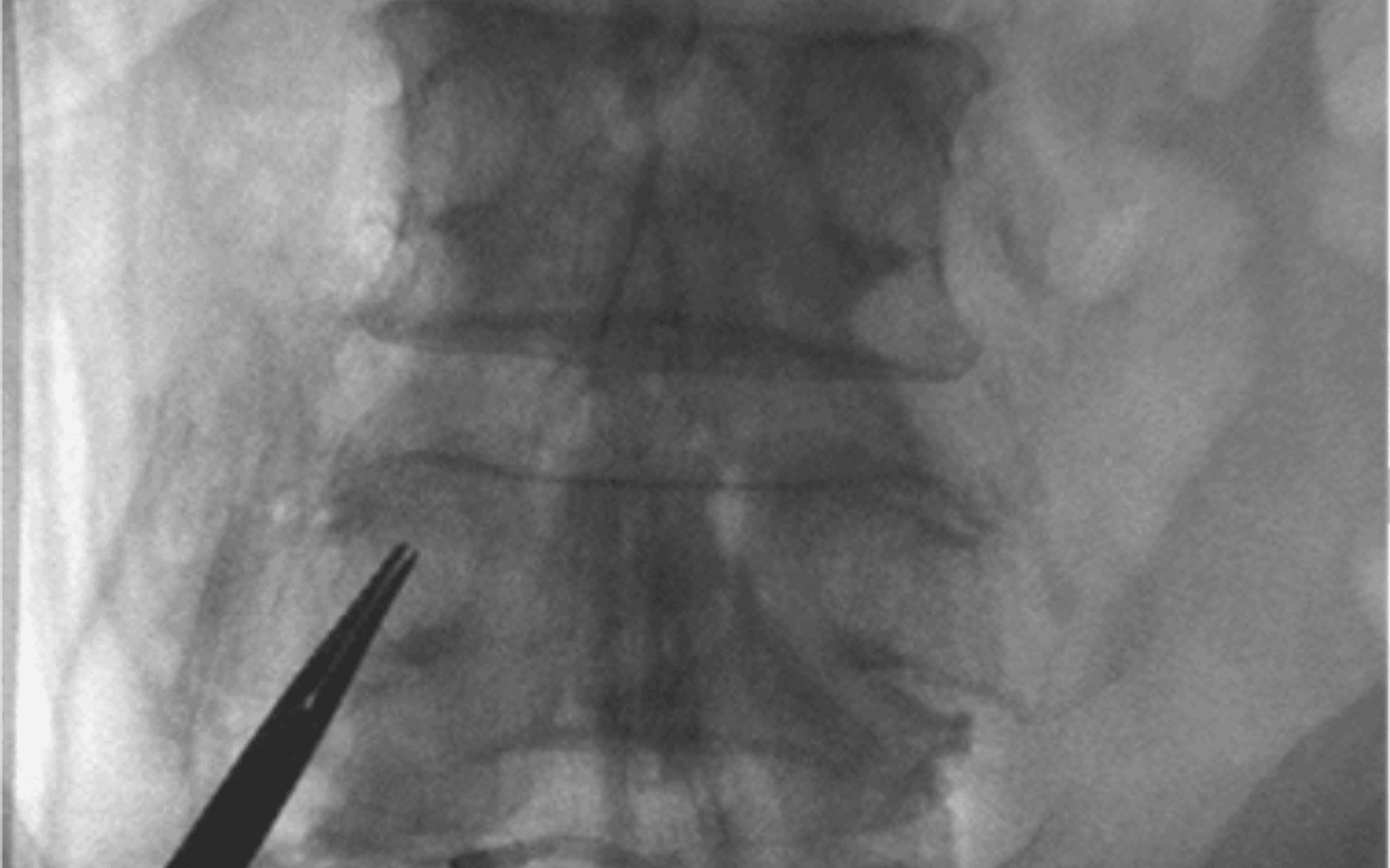 요추 신경성형술 카테터 이동을 확인하는 X-ray 영상