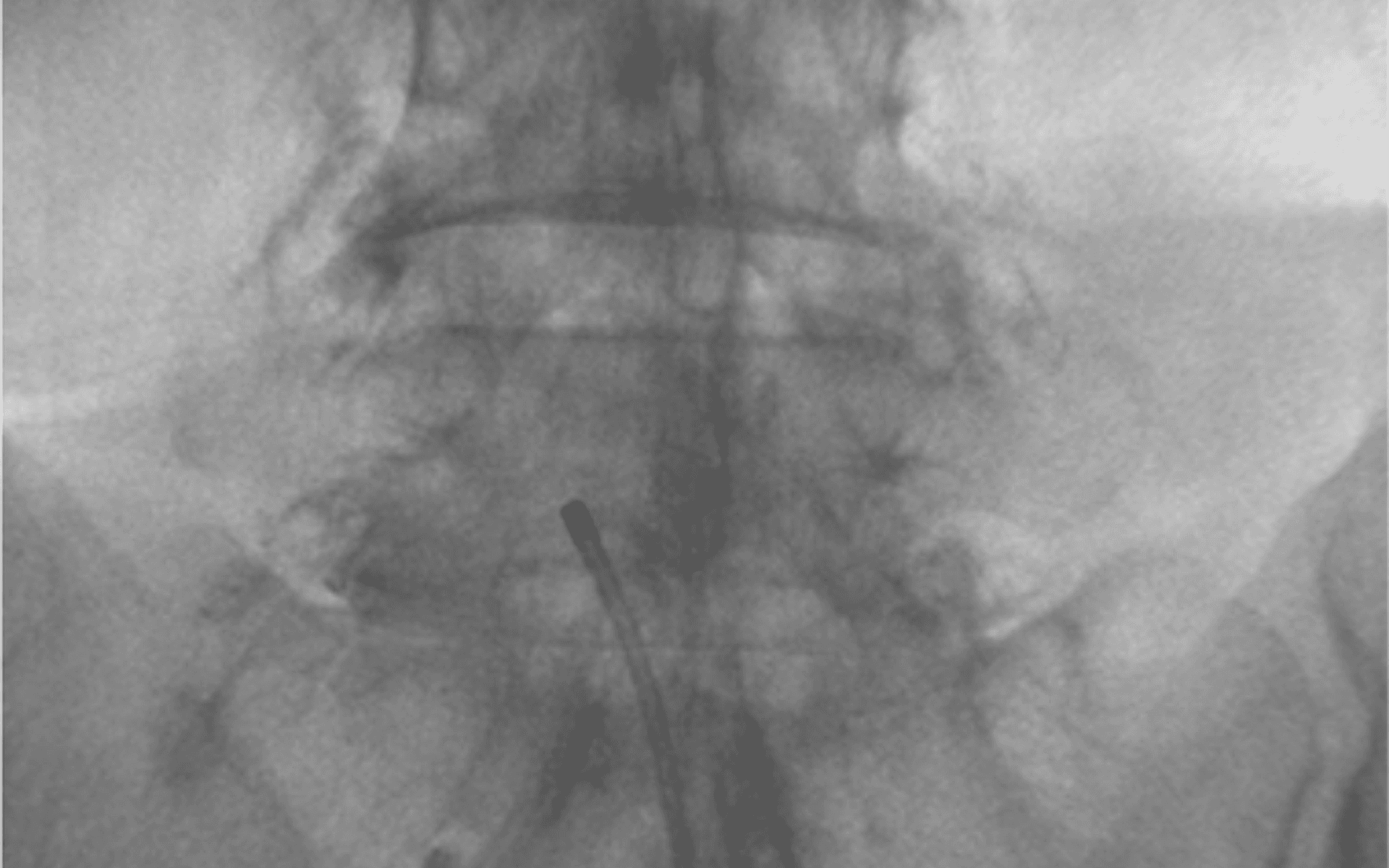요추 신경성형술 치료 후 상태를 확인하는 X-ray 영상