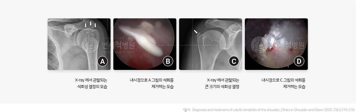 석회성 건염 시술과정