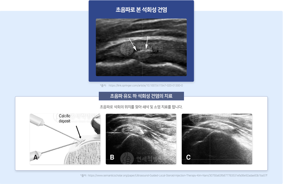 초음파 유도 하 석회성 건염의 치료