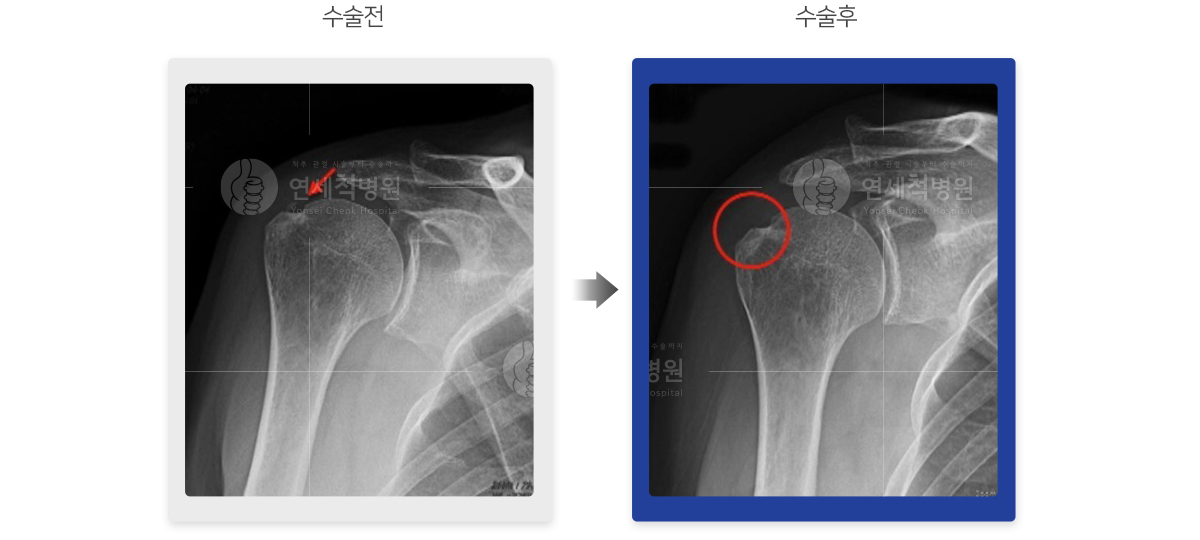 석회성 건염 치료 전후