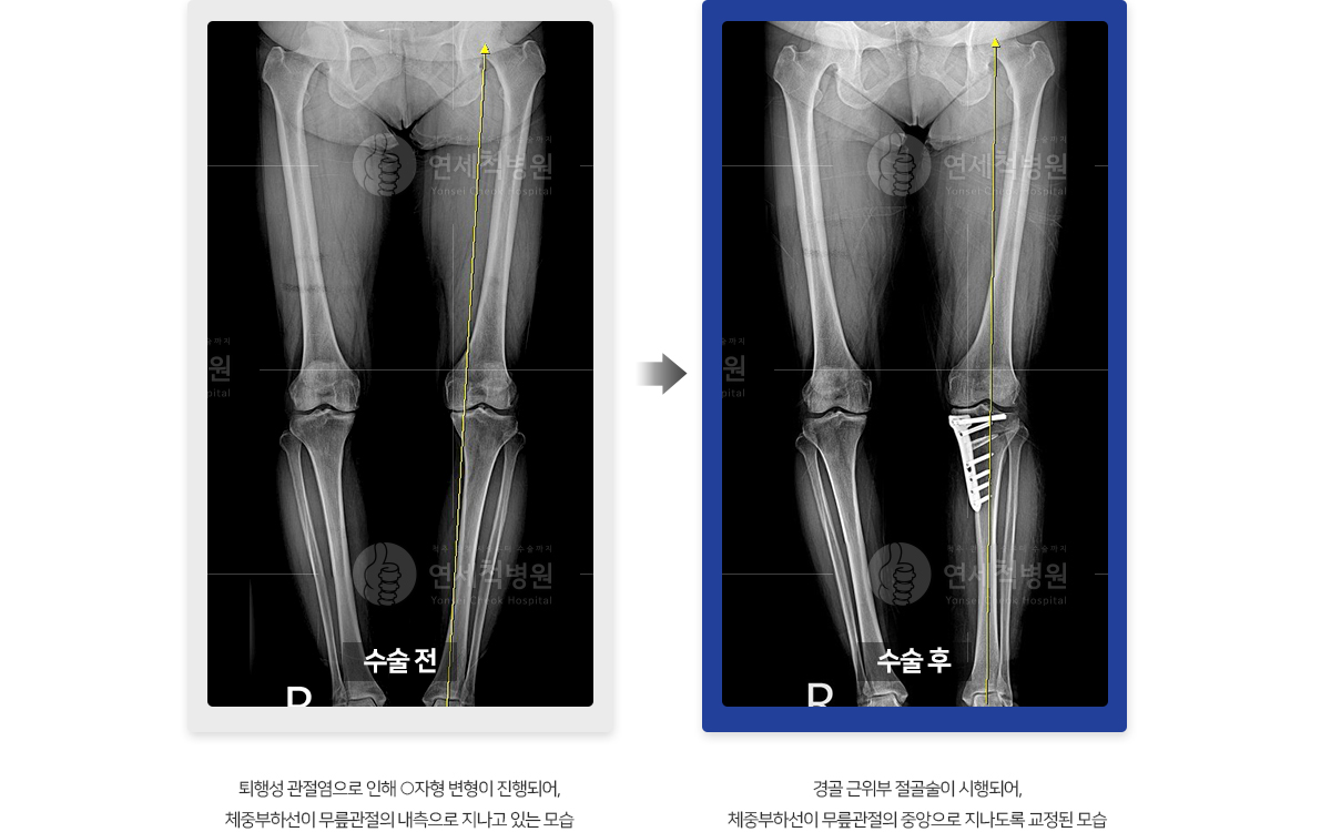 경골 근위부 절골술 전후 비교