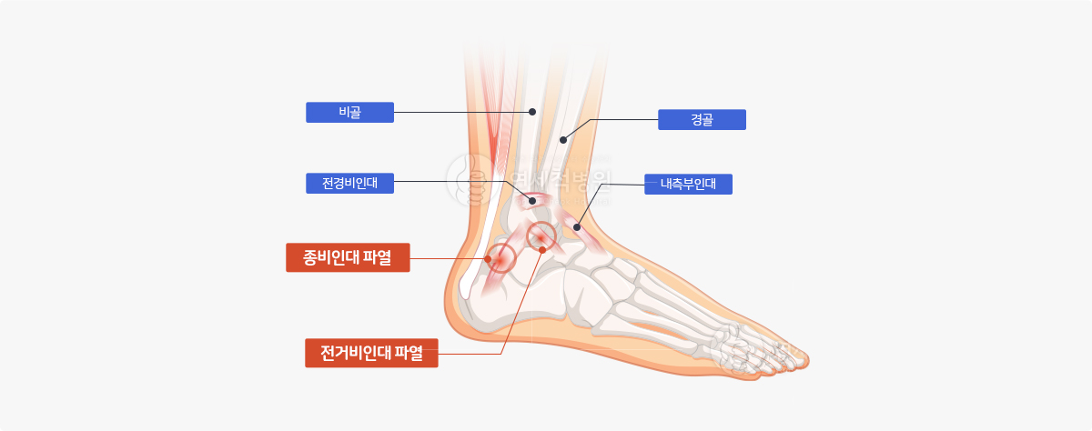 방아쇠 수지 예시 이미지