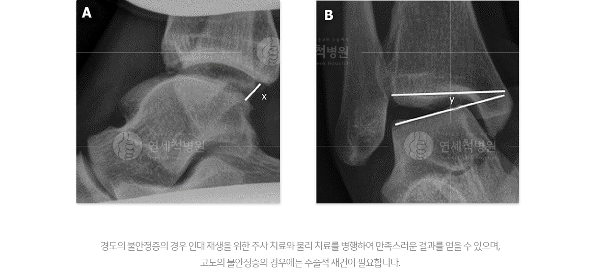 경도의 불안정증의 경우 인대 재생을 위한 주사 치료와 물리치료를 병행하여 만족스러운 결과를 얻을 수 있으며 고도의 불안정증의 경우에는 수술적 재건이 필요합니다.