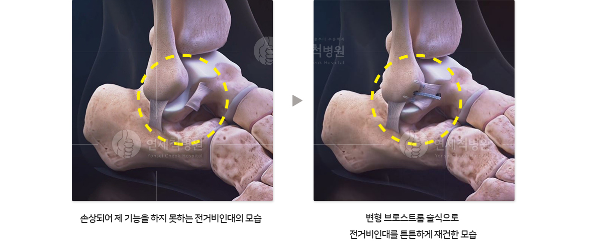 손상되어 제기능을 하지 못하는 전거배 인대에 수술적치료인 변형 브로스트롬 술식으로 전거비 인대를 튼튼하게 재건한 모습