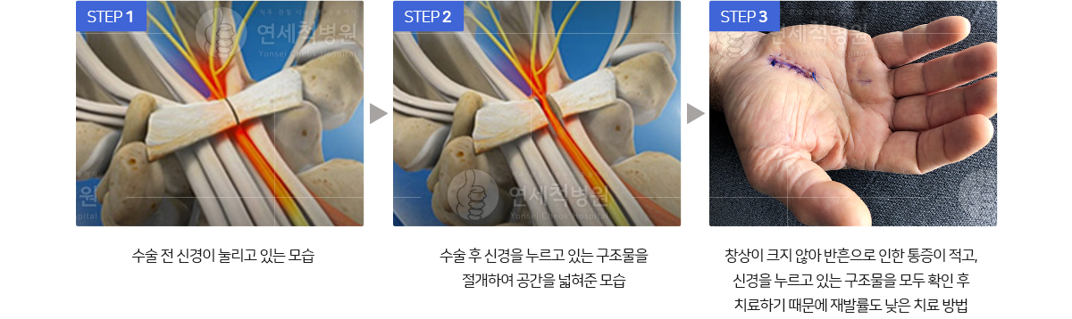 손목터널증후군 치료과정 이미지